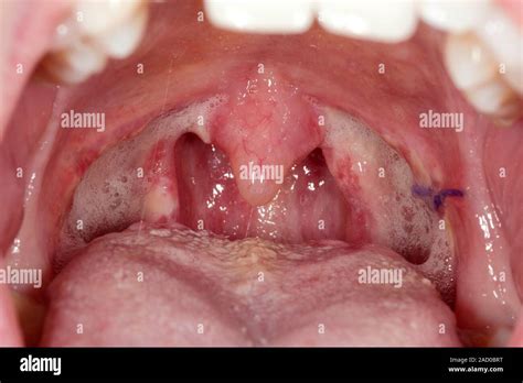 Throat After Tonsillectomy Close Up Of The Throat Of A 23 Year Old