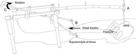 Skeletal Traction Femur Fracture