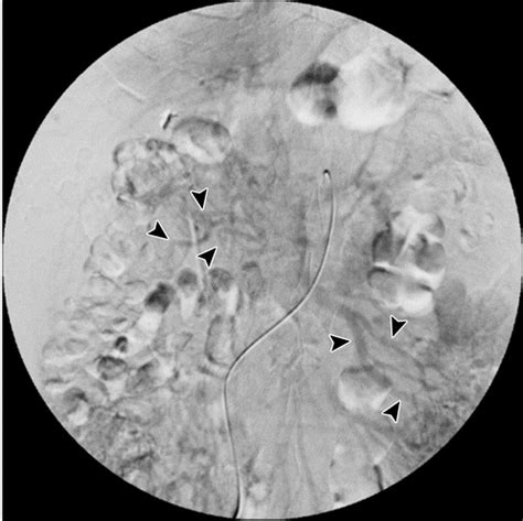 Acute Mesenteric Ischemia Multidetector Ct Findings And Endovascular