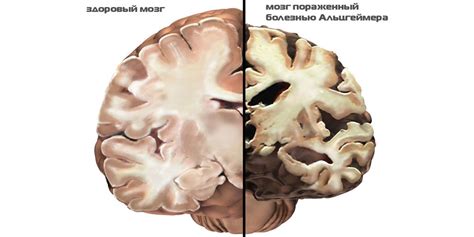 Болезнь вильсона и альцгеймера фото презентация