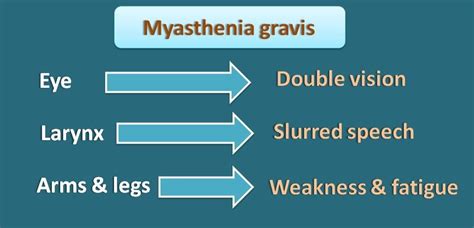 Tensilon test for diagnosis of Myasthenia gravis