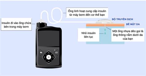 Liệu Pháp Bơm Insulin Một Lựa Chọn Nâng Cao Cho Việc Quản Lý Bệnh Tiể