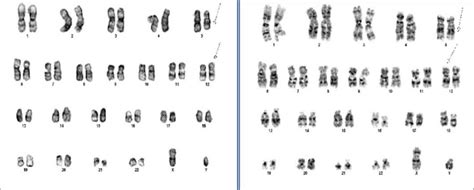 Karyotype Of The Patient S G Banded Bone Marrow Metaphase Cells Shows