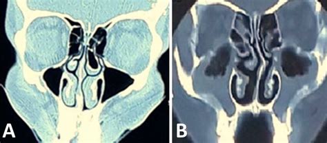 Coronal CT scan of the NPS (A) large left Concha bullosa and the ...