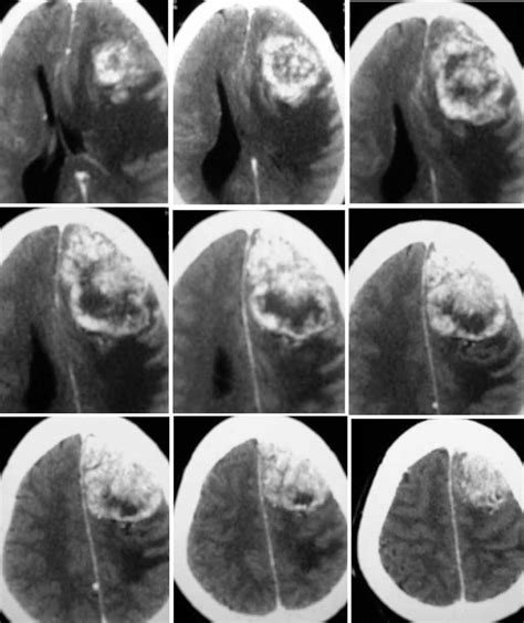 Preoperative Axial CT Scan Of Case 10 Showing Large Left Frontal