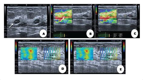 Diagnostic Value Of Strain Elastography And Shear Wave Elastography In