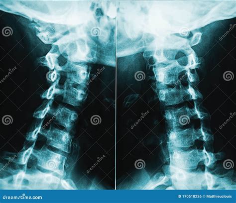 X Ray Image Or Radiography Of Human Neck Vertebrae Or Cervical Rachis