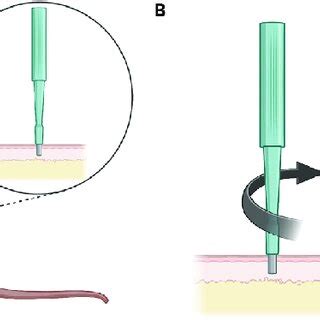 Performing the skin punch biopsy with a sterile disposable biopsy punch... | Download Scientific ...