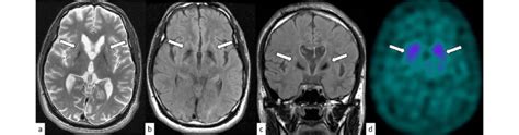 A Year Old Man With Huntington Disease T Weighted Axial Image A