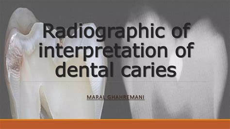 Radiographic Of Interpretation Of Dental Caries Ppt