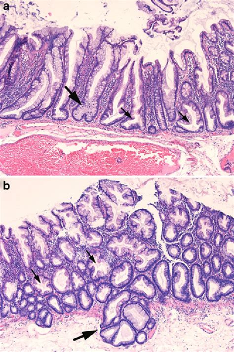 Figure 3 from Serrated polyps of the colon and rectum | Semantic Scholar