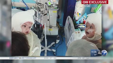 Conjoined Twins Update Jadon Anias See Each Other For First Time Abc7 Chicago