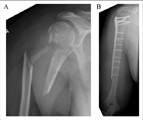 A Complex Metadiaphyseal Proximal Humeral Fracture In Geriatric Host