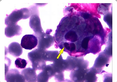 Wright Giemsa Stain Of The Patients Bone Marrow Aspirate With An Arrow Download Scientific