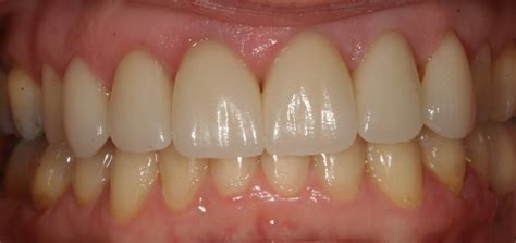 Inlays Onlays Crowns And Bridges Dr Maria Chartz Cosmetic Dentistry