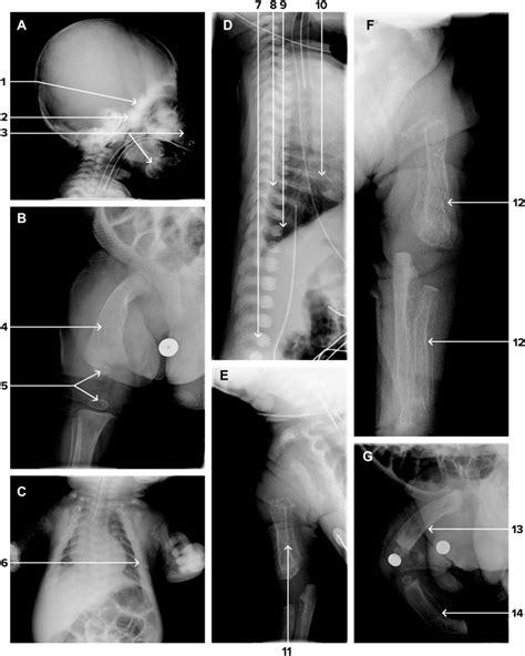 Mucolipidosis II The Journal Of Pediatrics