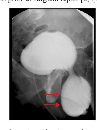 Figure 1 From A Scrotal Cystocele Semantic Scholar