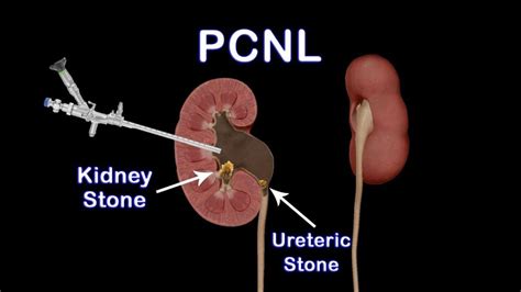 Kidney Stone Surgery PCNL Hospital Jalandhar Punjab - Jammu Hospital