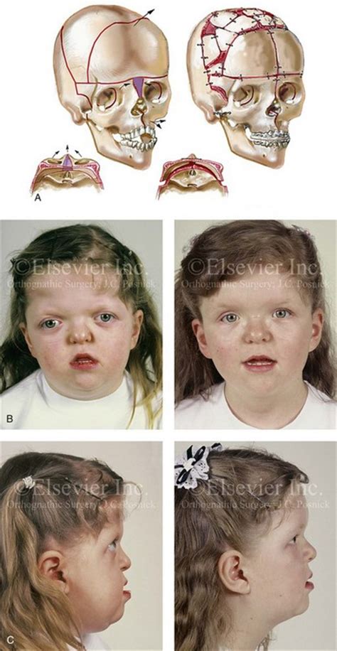 30 Syndromes With Craniosynostosis Evaluation And Treatment Pocket