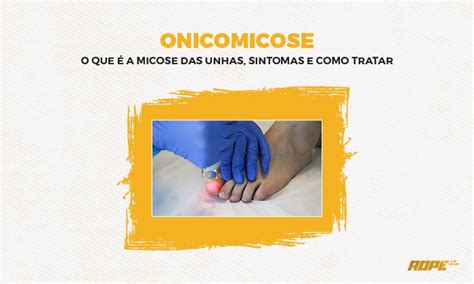 Onicomicose O Que é A Micose Das Unhas Sintomas E Como Tratar Rope