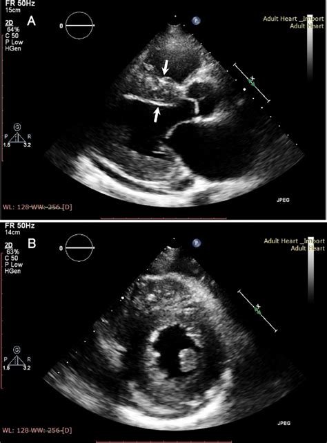 Combina O Cercado Luva B Mode Echocardiography Maldi O Cartaz Megalopolis