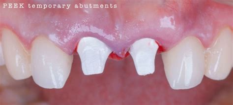 Immediate Implant Placement And Periimplant Bone Augmentation Using