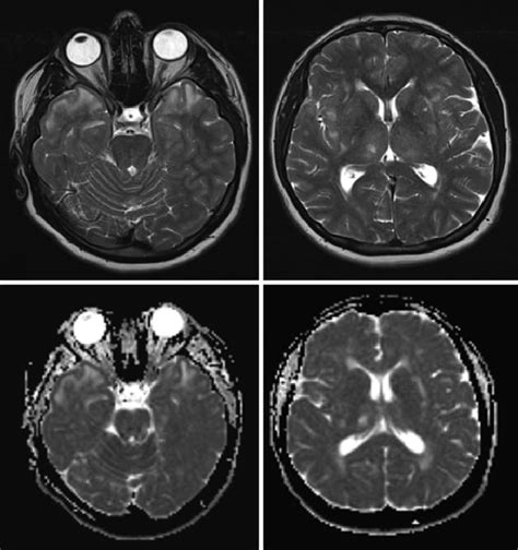 Bilateral hyperintense lesions in the anterior temporal lobe and the ...