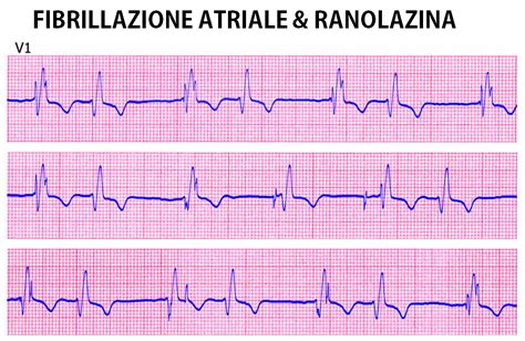 Fibrillazione Atriale E Strategia Con Ranolazina Nurse Times