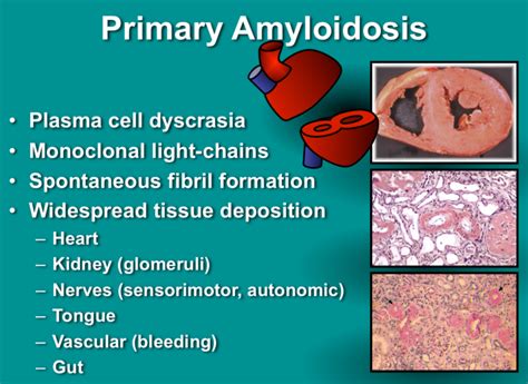 Amyloidosis Causes Types Symptoms Treatments Prognosis How To