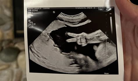 Fetus S Gesture In Ultrasound Photo Catches Parents By Surprise We