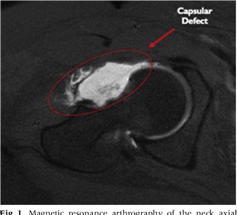 Figure 1 From Arthroscopic Treatment Of Hip Dislocation After Previous