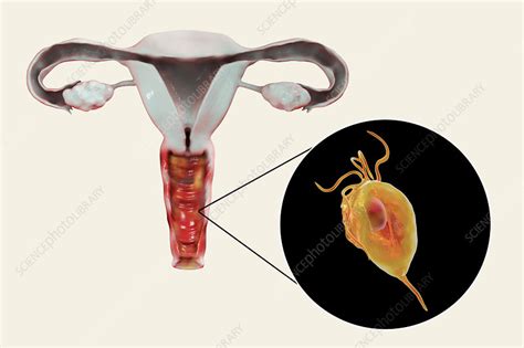 Trichomoniasis Illustration Stock Image F Science Photo