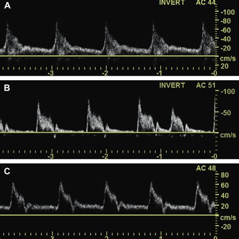 Branches Of The Aortic Arch And Extracranial Cerebral Arteries Va