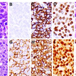 Morphologic And Immunophenotypic Features Of Plasmablastic Lymphomas