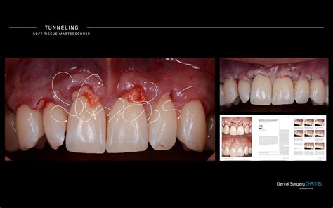 Curso De Manejo E Injerto De Tejidos Blandos Parte