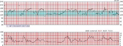 Mise à jour technique no 429 Artéfact de la fréquence cardiaque