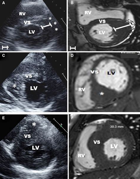 How To Image Hypertrophic Cardiomyopathy Circulation Cardiovascular