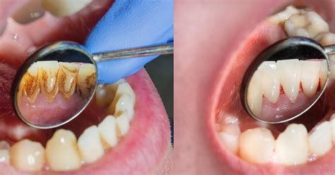 Periodontitis Cl Nica Saga