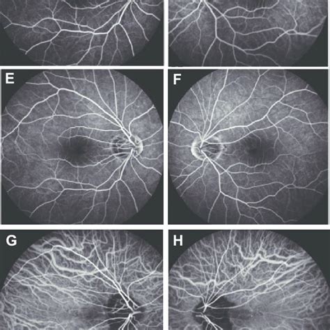 Fundus Photography Fluorescein Angiography And Indocyanine Green