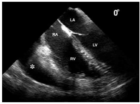 Tintinalli Time: Cardiac Trauma | emerJencyWEBB