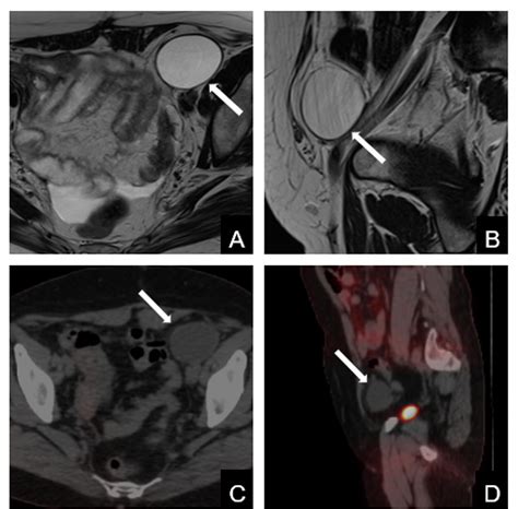 Multimodality imaging features of Canal-of-Nuck hydrocele in adults - Clinical Imaging