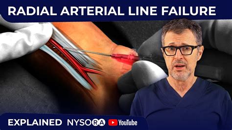 Radial Arterial Line Failure Youtube