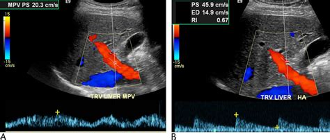 Duplex Doppler Ultrasound Of The Hepatic Artery A Window To