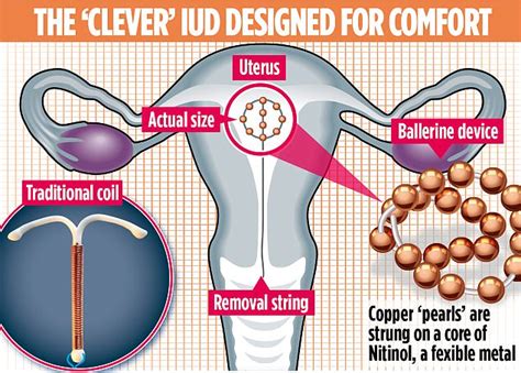 The Pioneering Contraceptive Ball That Could Replace Coils Daily Mail