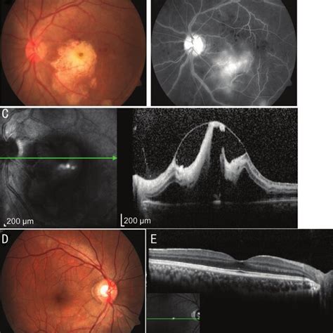 Fundus Images At Presentation A Color Fundus Photography Of The Left