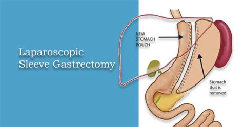 Laparoscopic Sleeve Gastrectomy For Weight Loss 30 Bmi Patients