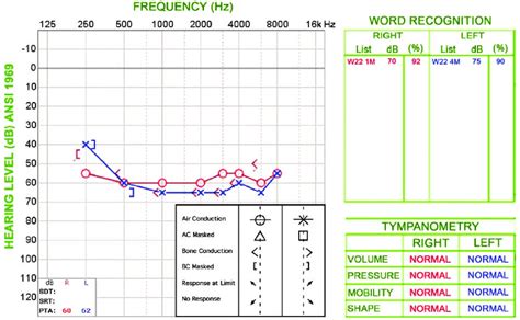 Seven weeks after the audiogram in Figure 1, the sensorineural hearing ...