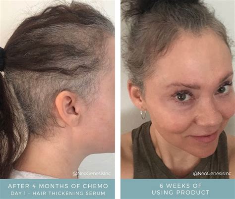 Before After Chemo Hair Lash Brow Loss Neogenesis