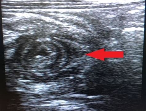 Ultrasound Of The Abdomen Showing A Typical Target Sign Red Arrow Download Scientific Diagram