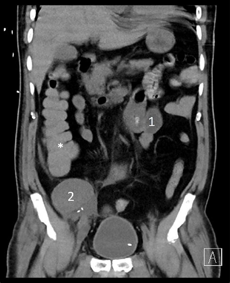 Non Contrast Abdominal Ct Scan Demonstrating Hyperintense Fluid In The Download Scientific